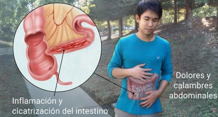 La enfermedad de Crohn